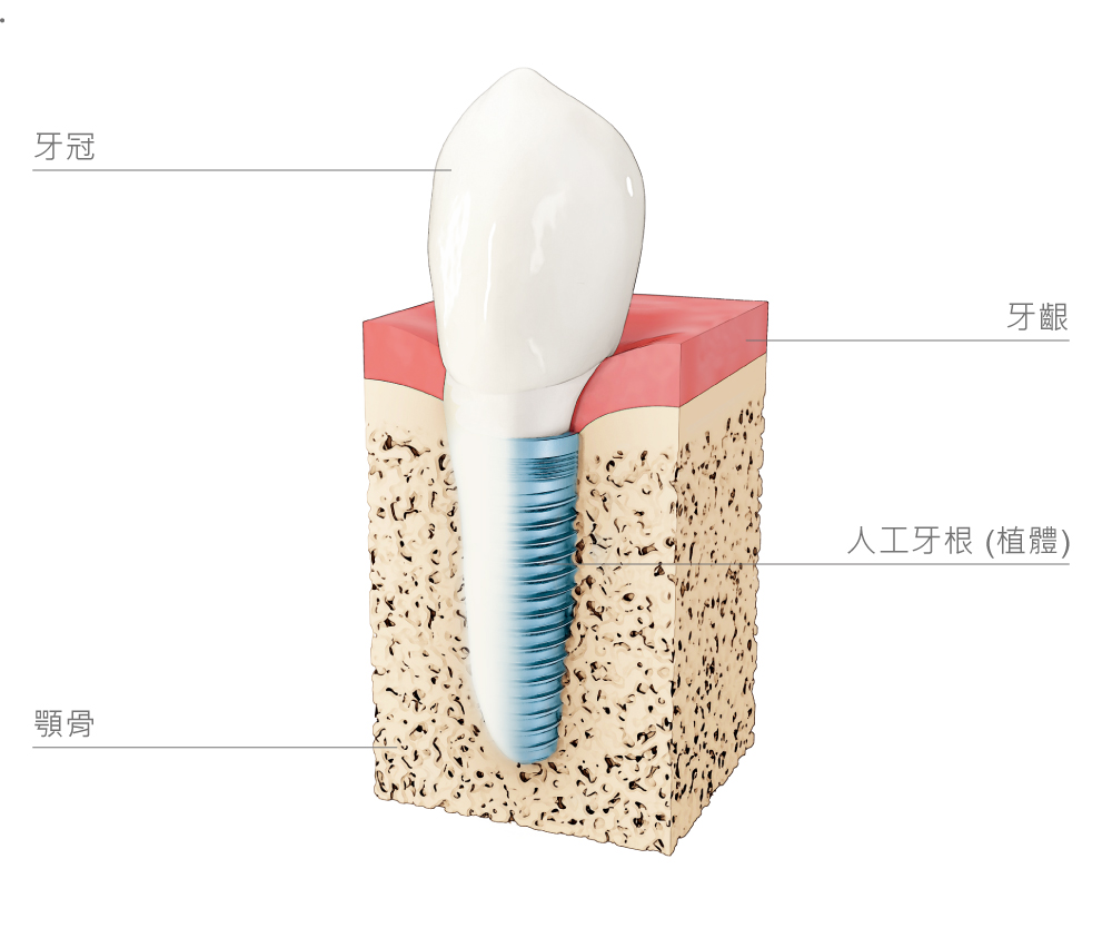 人工牙根 (植體)