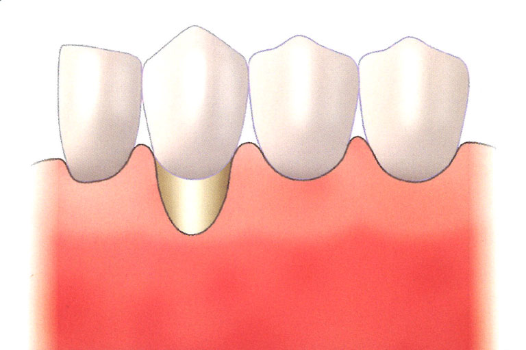牙齦過薄或固著式牙齦寬度不足時，易造成牙齦退縮或刷牙時不舒適