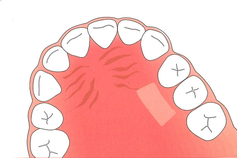選取口內其他部位豐厚的牙齦組織