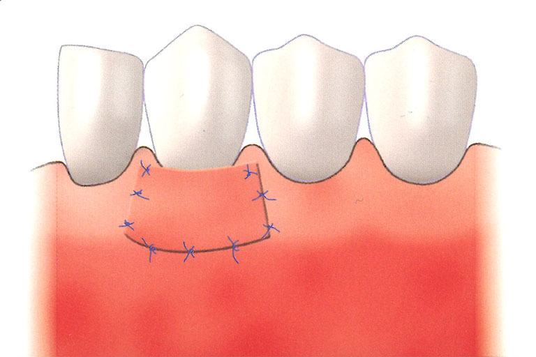 縫合於牙齦不足處