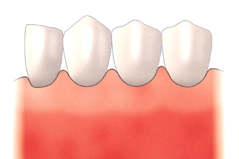良好的牙齦結構可長期保護牙齒或人工植牙