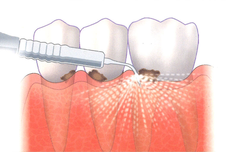 定期洗牙能預防牙周病