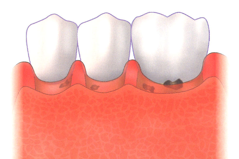 若牙結石堆積己深入牙齦內側，助長牙菌斑附著細菌生長，導致牙周組織破壞