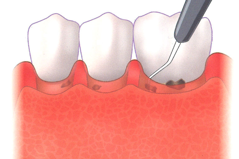 將器械深入牙周囊袋中，施行牙結石刮除及牙根整平術，清除牙周囊袋內藏匿的病源