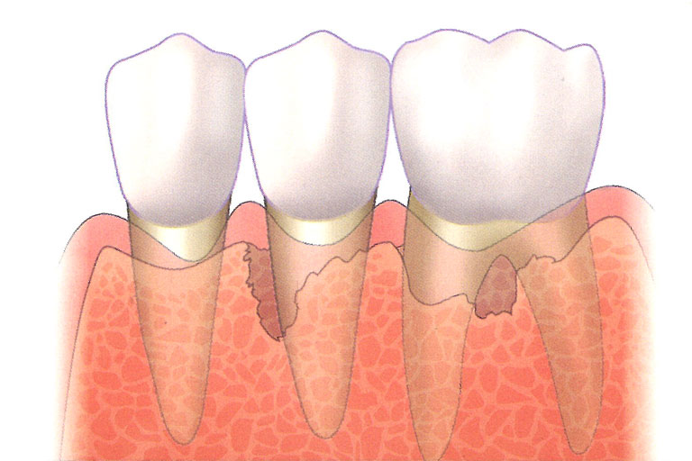 當牙齒周圍骨缺損較深入，經過深度清潔與治療，仍未能有效地降低牙周囊袋時