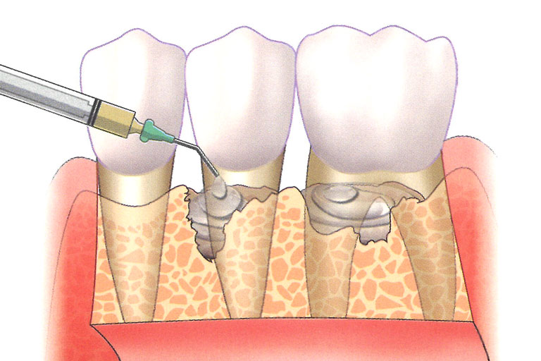 可經由手術清創，在牙根表面塗佈生物蛋白或生長激素，協助牙周韌帶與骨的再生