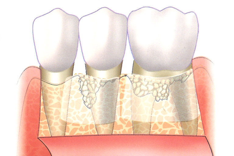 或在骨缺操處以骨粉充填，並覆蓋再生膜，提供牙周組織生長的空間