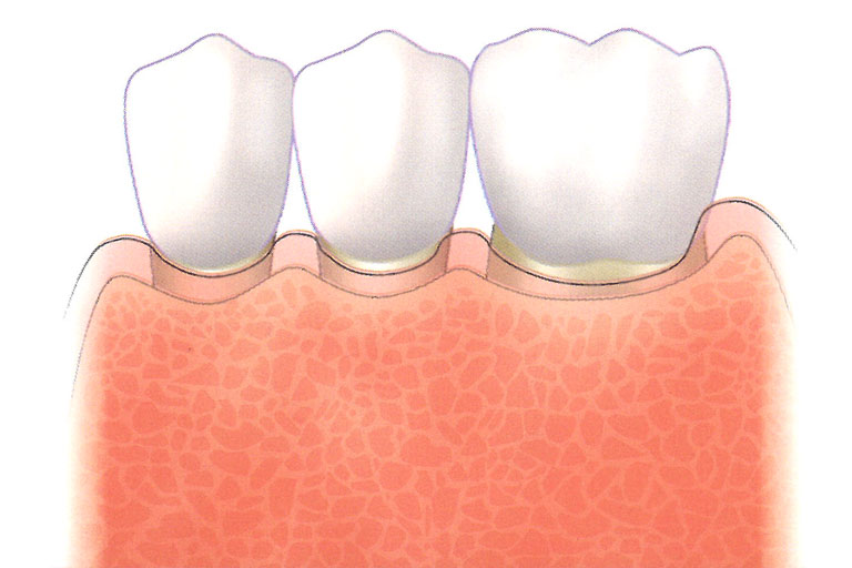 傷口癒合後牙周組織增加了，也提供了牙齒長久存活機會