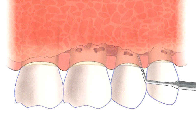中重度牙周病骨缺損較深入，以非手術性治療無法有效降低囊袋時