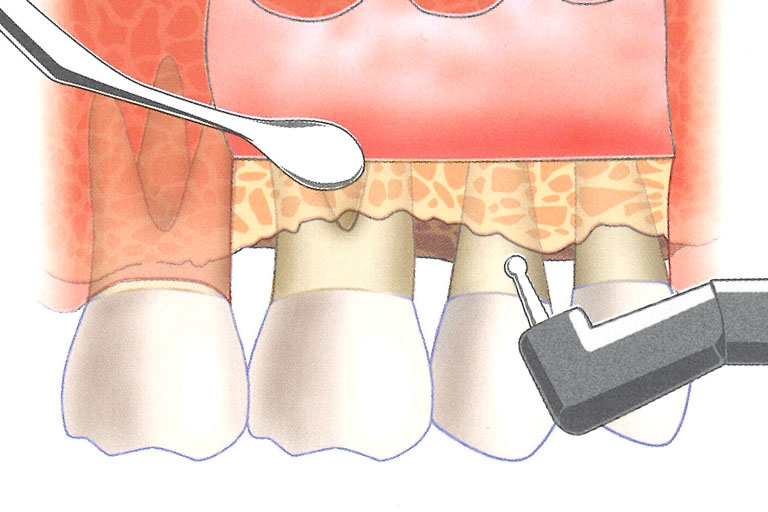 徹底清潔牙根表面，修整牙齒周圍骨缺損
