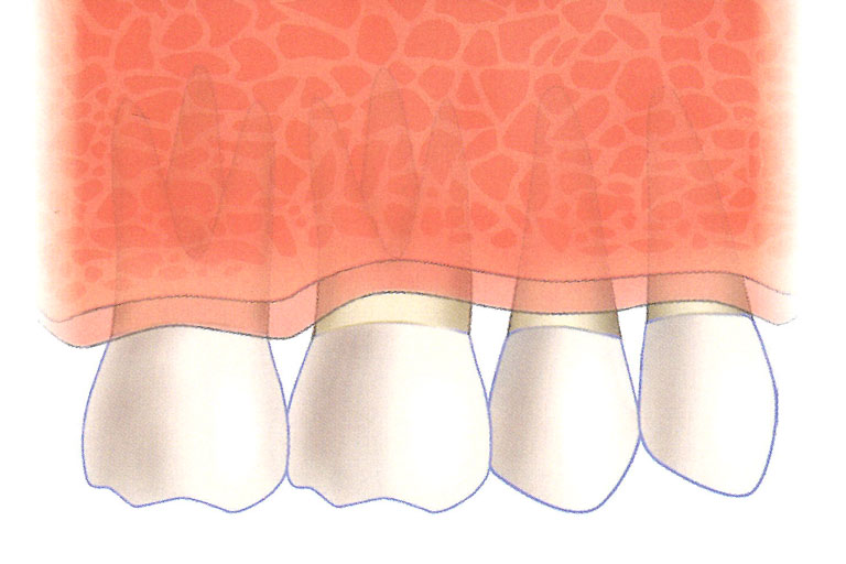 癒合後牙周囊袋改善，有助牙周健康的維護