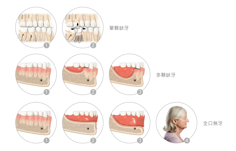失去牙齒對於顎骨與牙齦的影響